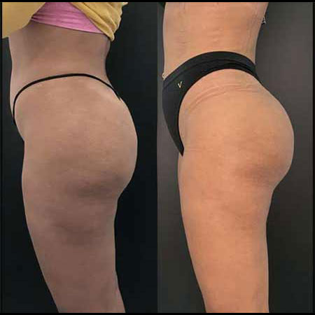 What Side Effects Are Normal After a Brazilian Butt Lift?