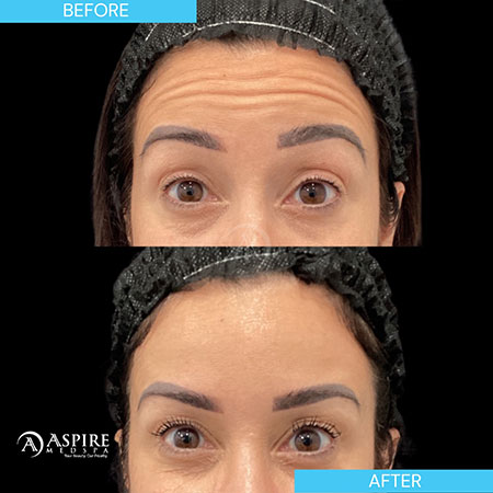 before and after botox injections in Tampa