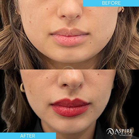 before and after botox injections in Tampa
