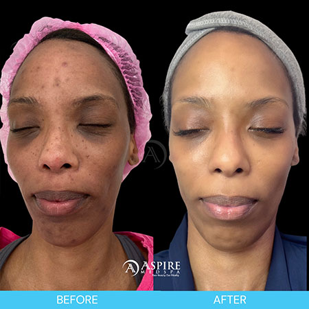 woman's face after hydrafacial in tampa