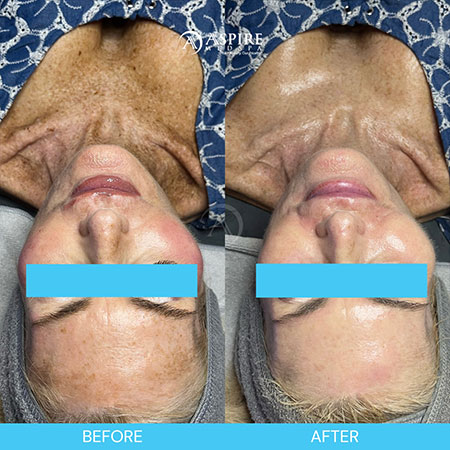 arial view of before and after a hydrafacial in tampa