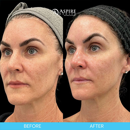 woman before and after her hydrafacial in tampa