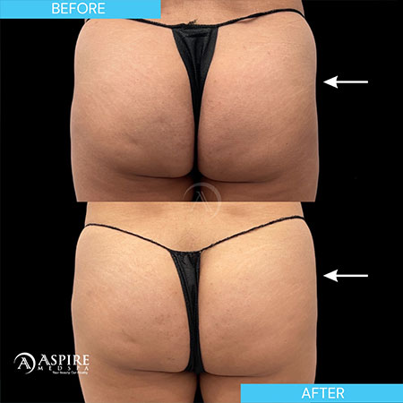 before and after non surgical BBL in Tampa